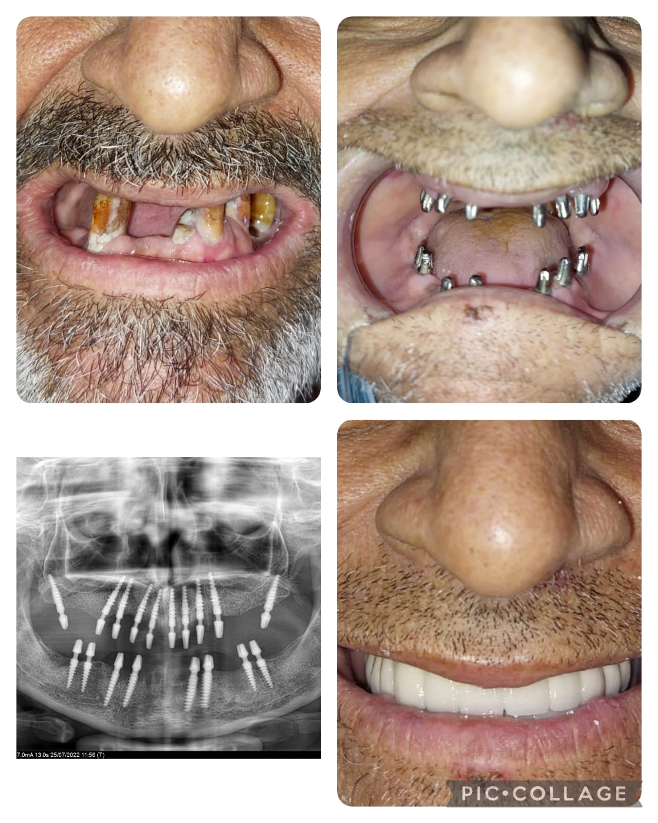 Dental Implant