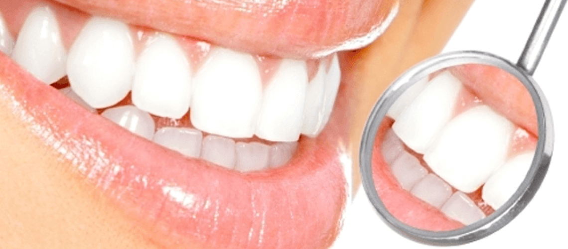 Teeth-Whitening-1